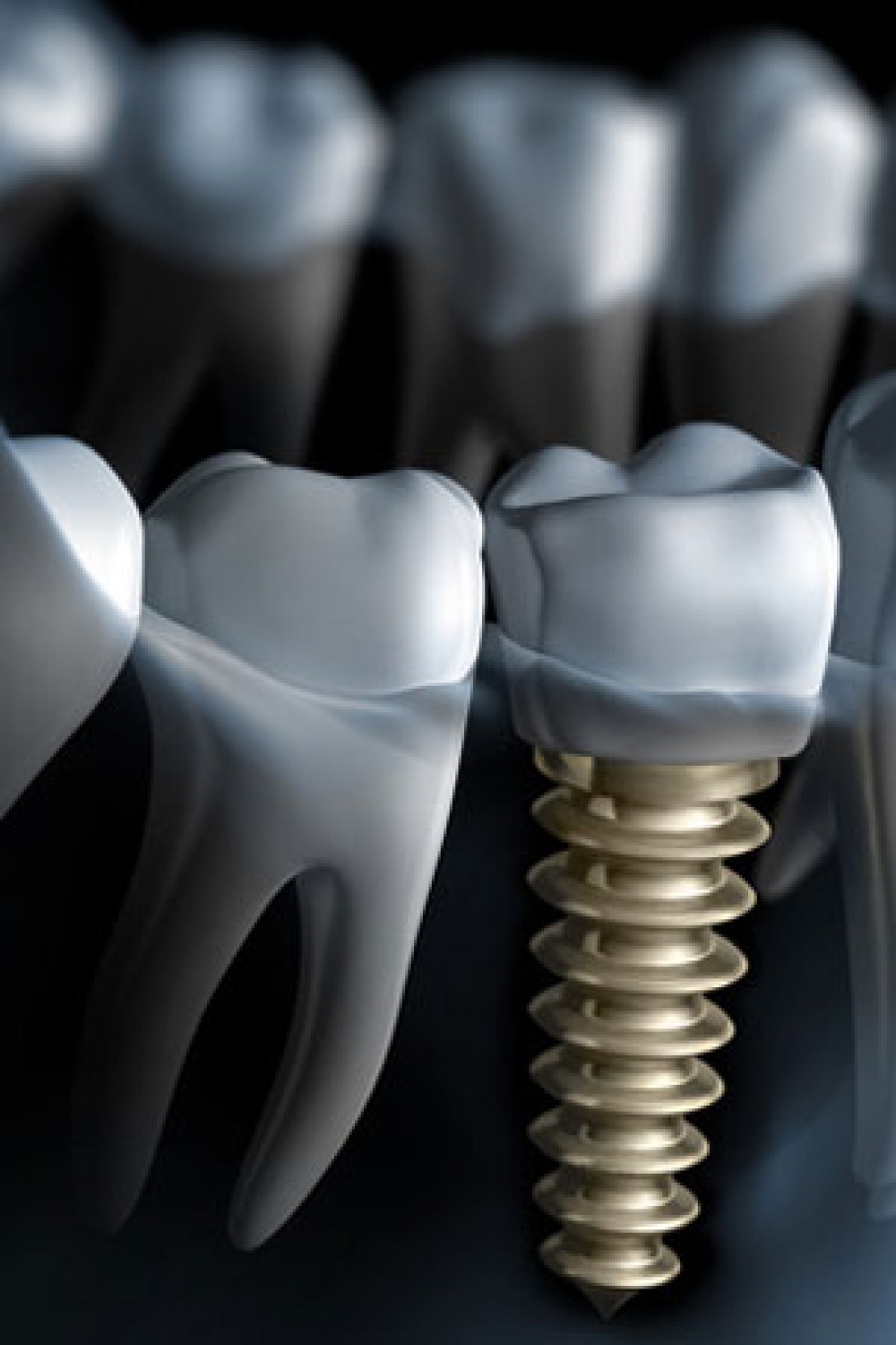 dental-implant-4