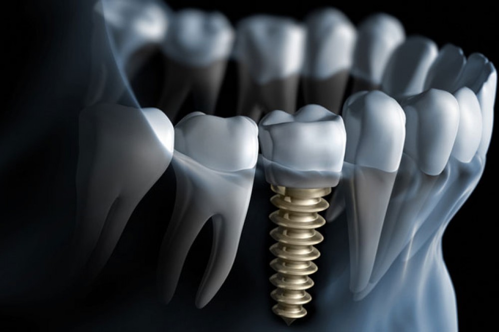 dental-implant-4